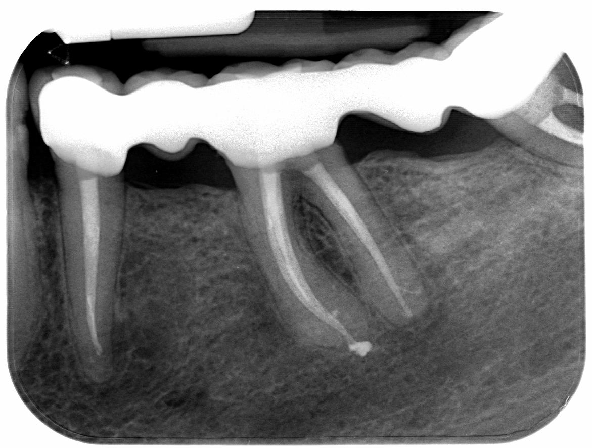 Röntgenbild einer Zahnbehandlung